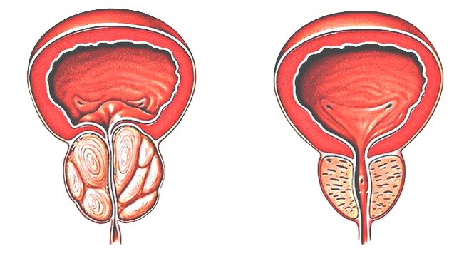 Головка простата. Аденома предстательной железы рисунок. Аденома предстательная железа у мужчин. Простит аденома простаты.