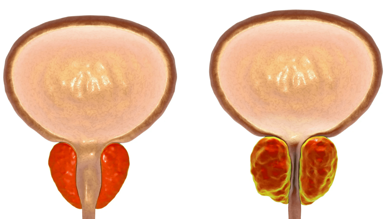 Що таке простатит