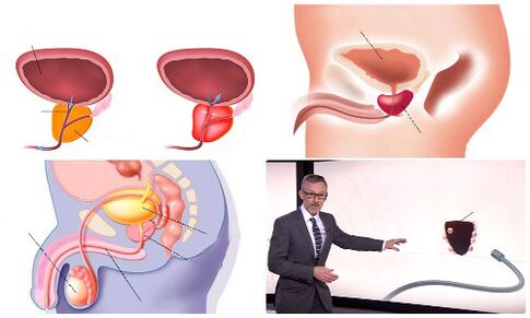здорова та хвора простата
